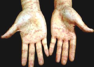 梅毒是怎么得的?传播途径有哪些?_柳市同济医